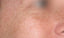 cosmo-peel-forte-patient-before