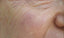 Cosmo-Peel-20-Patient-1-before
