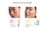 HYAL CEUTIC REDENS+