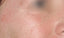 cosmo-peel-forte-patient-after